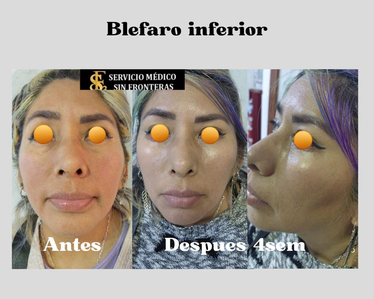 Resultado Blefaroplastia 5
